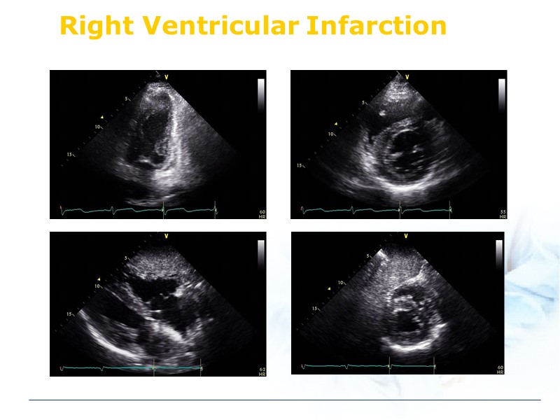 Right Ventricular Infarction